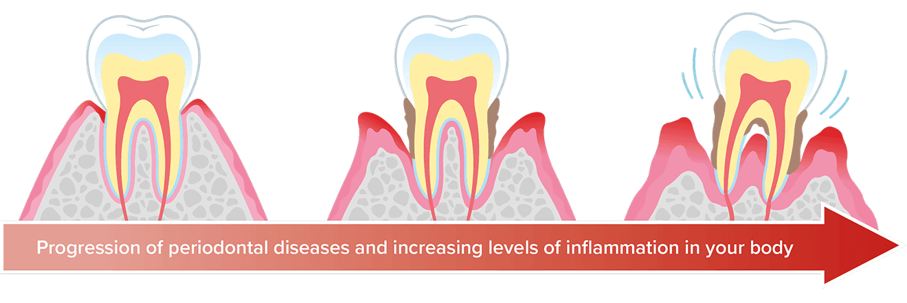 https://prod.tepe.com/globalassets/images/uk-images/perio--diabetes-page/periodontal-disease-stages-1320x442.png